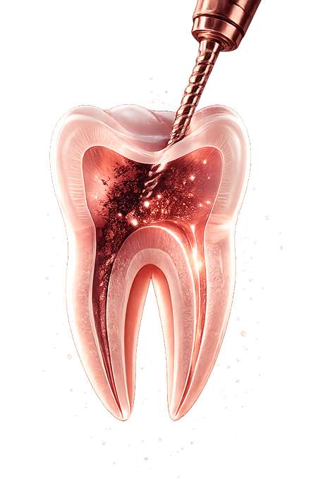 Root Canal Treatment